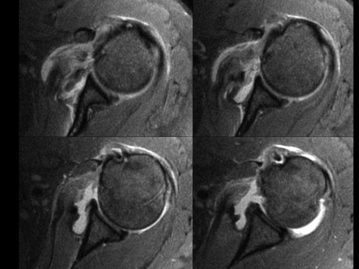 Figure 4 for case subscapularis tendon ( RID1951 )